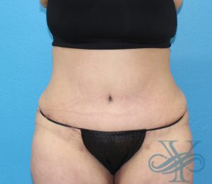 after abdominoplasty front view