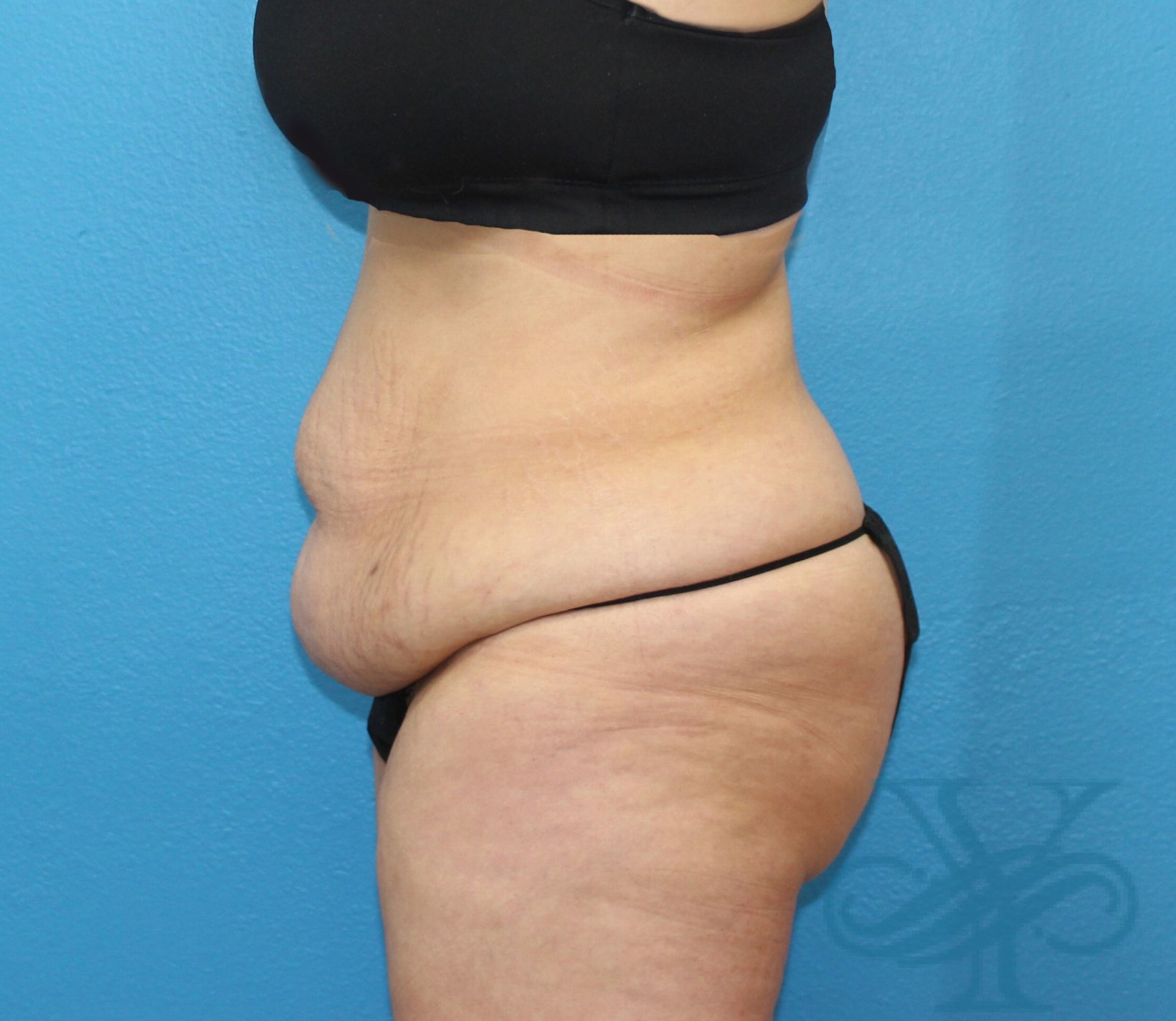 before abdominoplasty left profile view