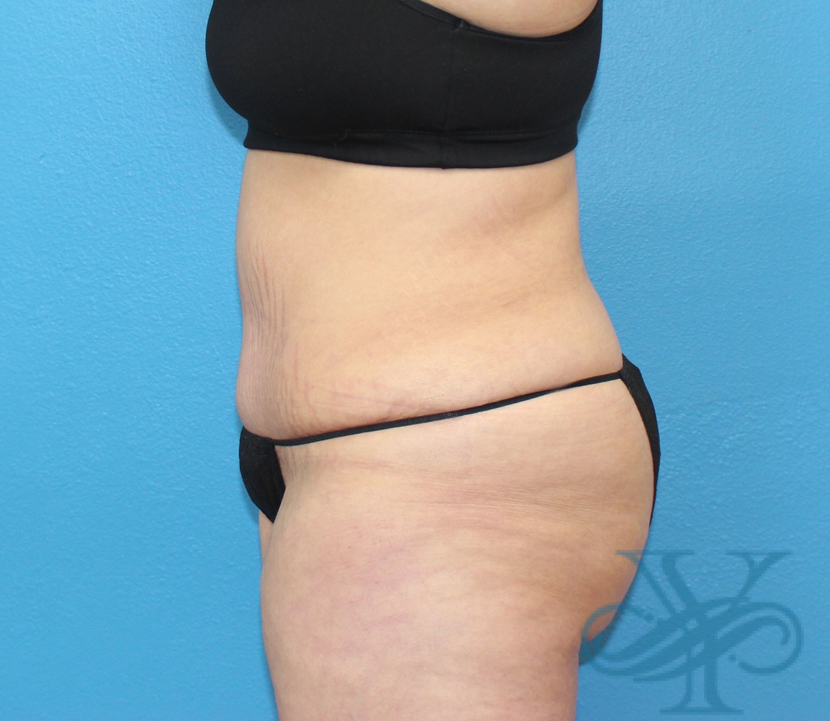 after abdominoplasty left profile view