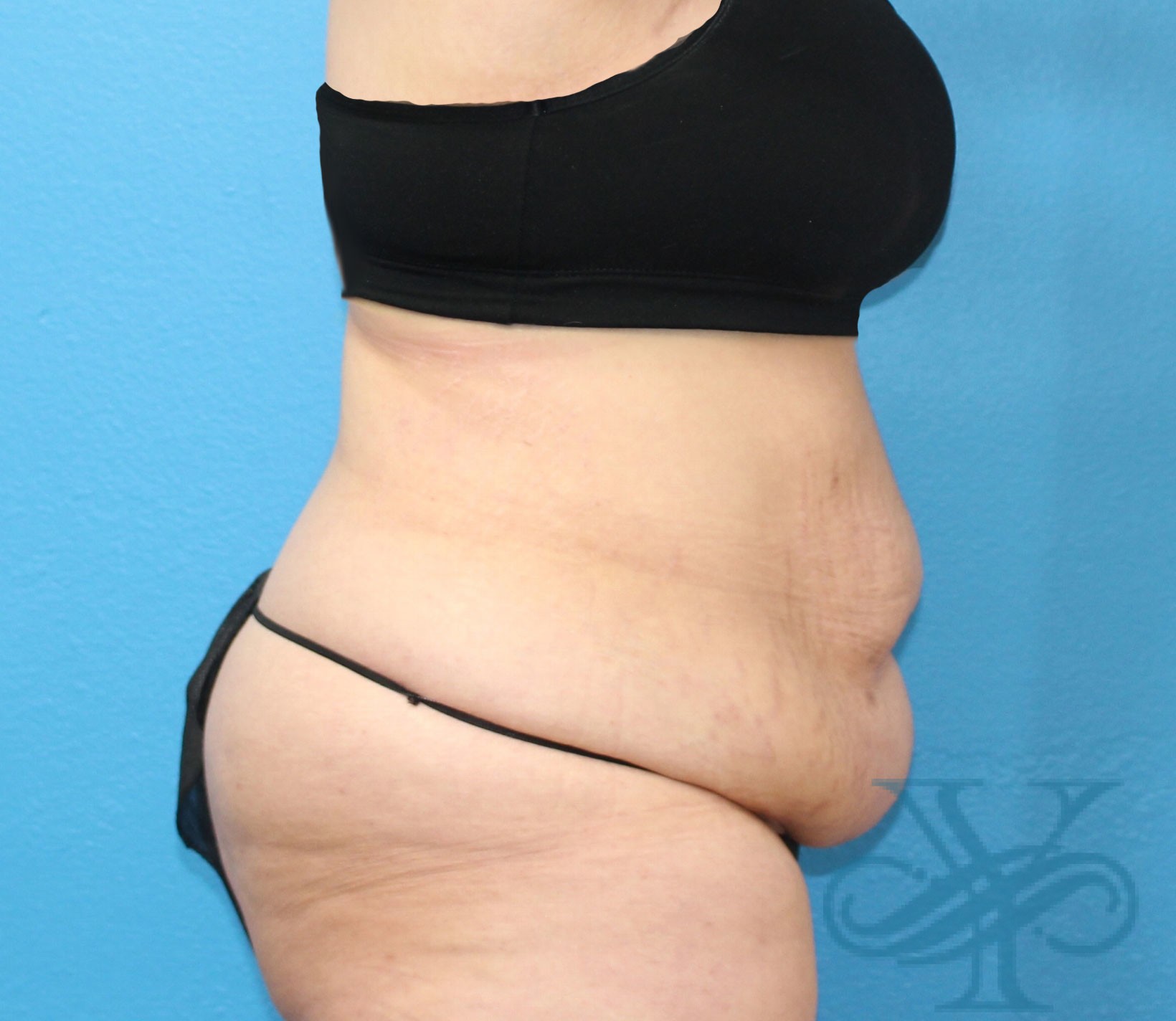 before tummy tuck right profile view