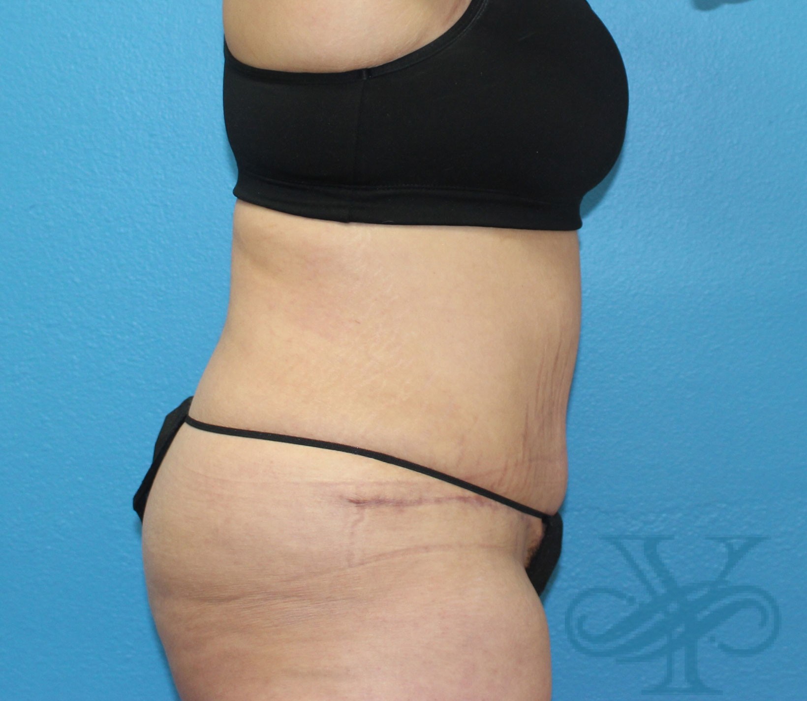 after tummy tuck right profile view