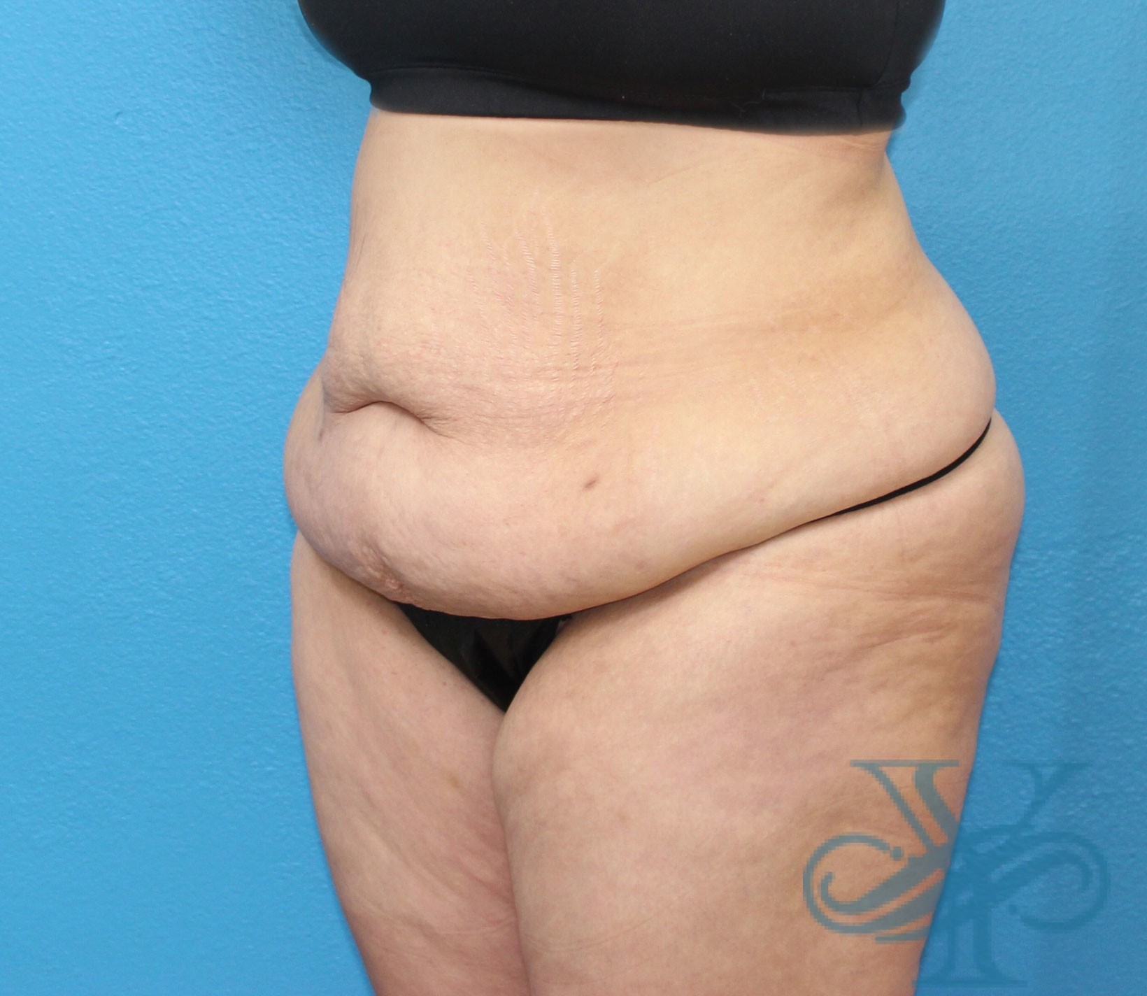 before tummy tuck left oblique view