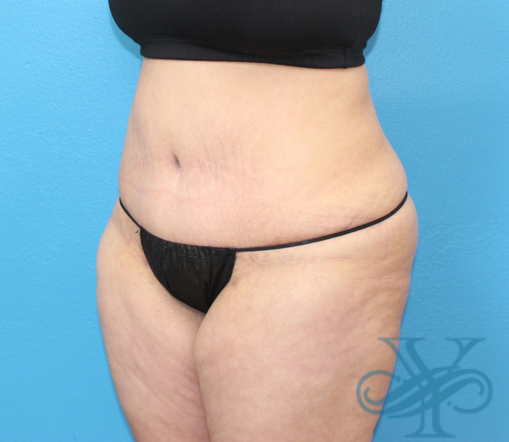 after tummy tuck left oblique view