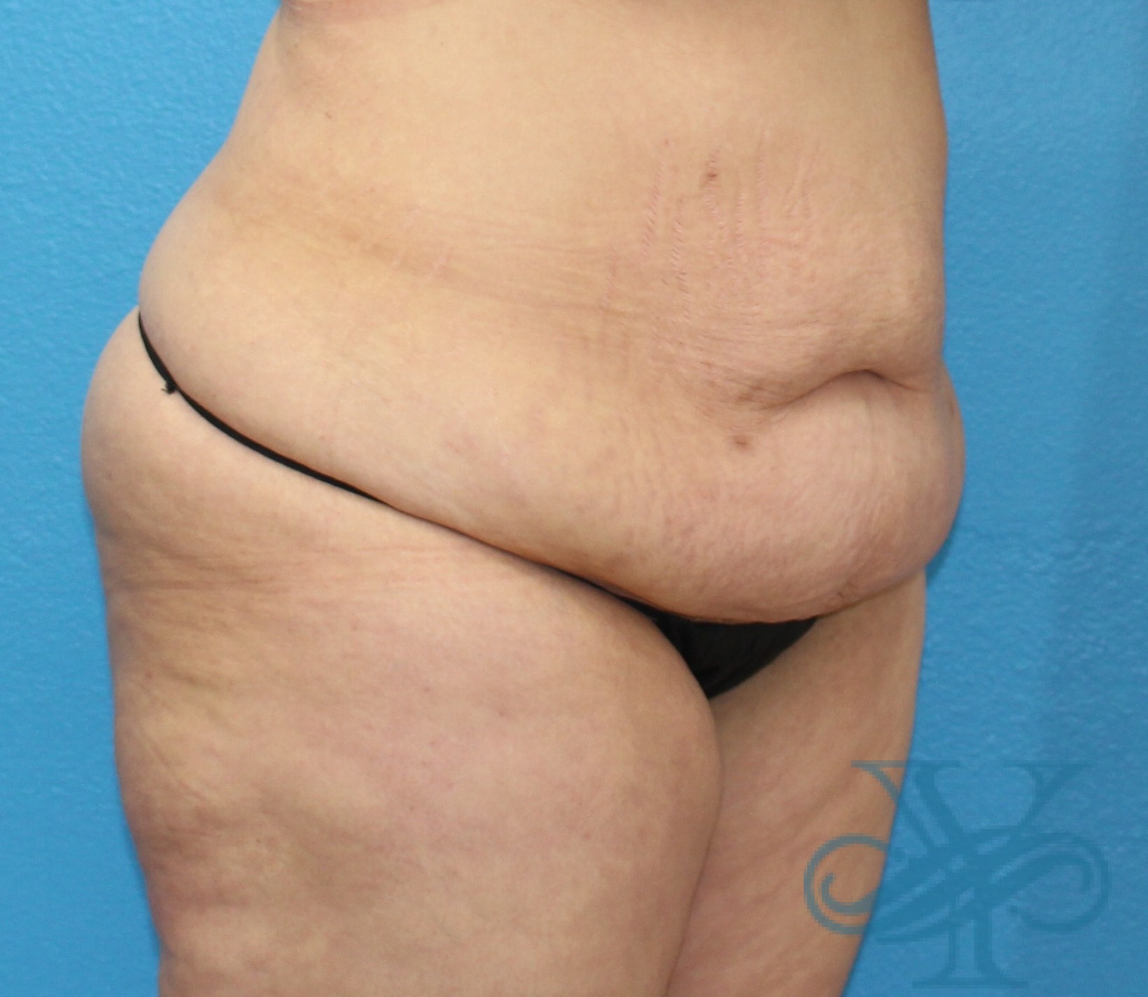 before tummy tuck right oblique view