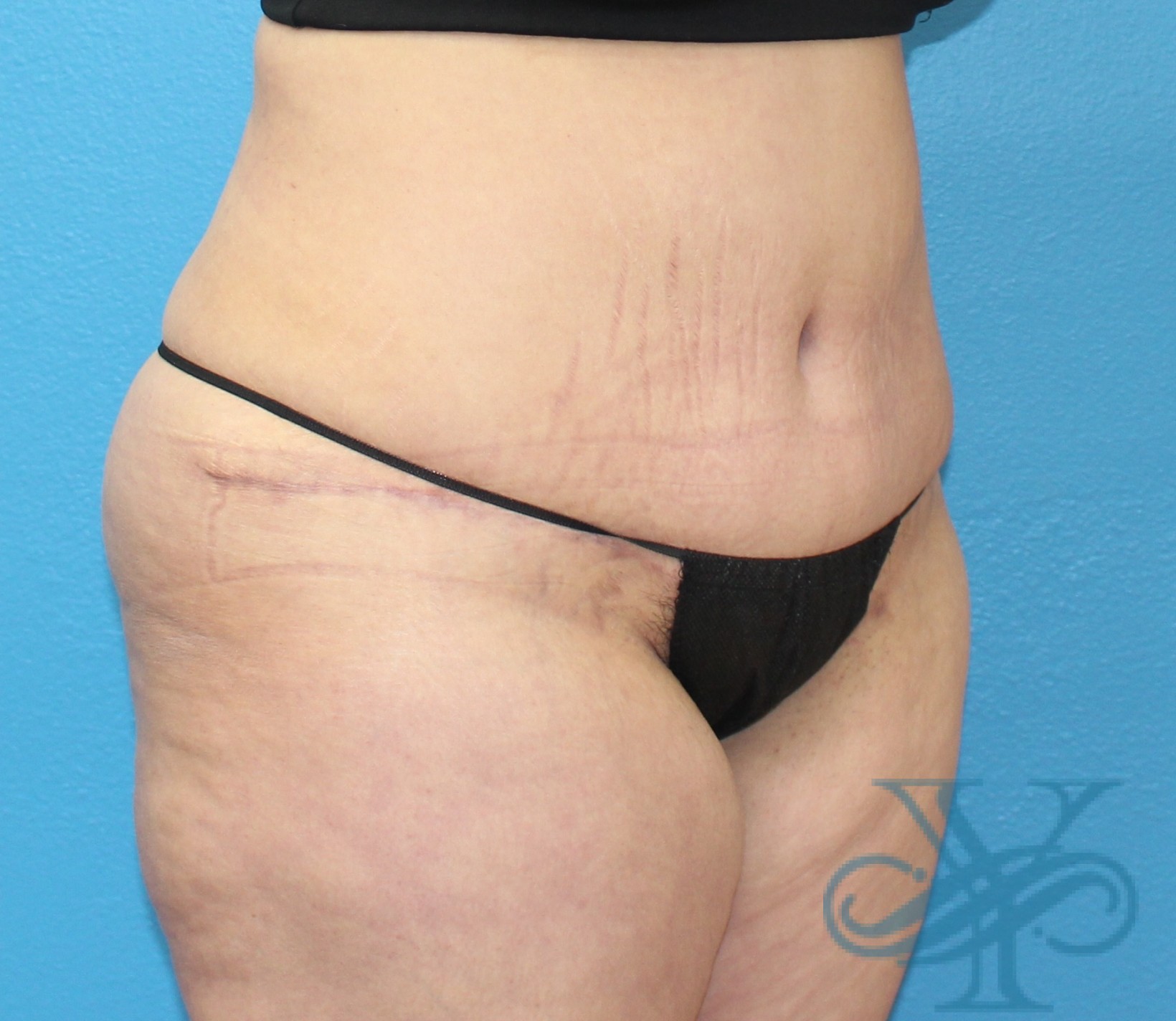 after tummy tuck left oblique view