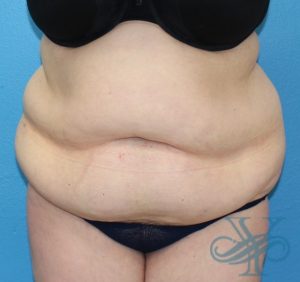 Before abdominoplasty Dr. Yegiyants, Santa Barbara, CA