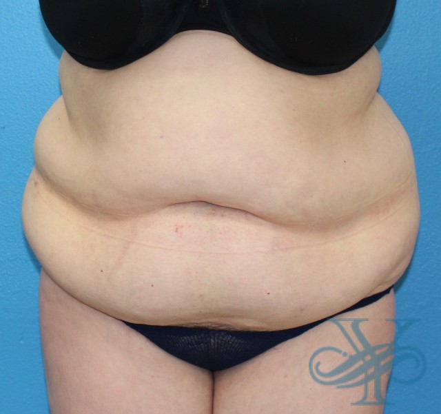Before abdominoplasty Dr. Yegiyants, Santa Barbara, CA