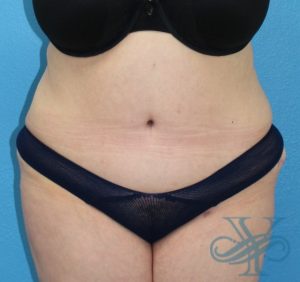After abdominoplasty Dr. Yegiyants, Santa Barbara, CA