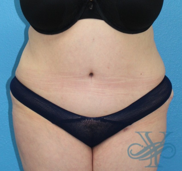 After abdominoplasty Dr. Yegiyants, Santa Barbara, CA