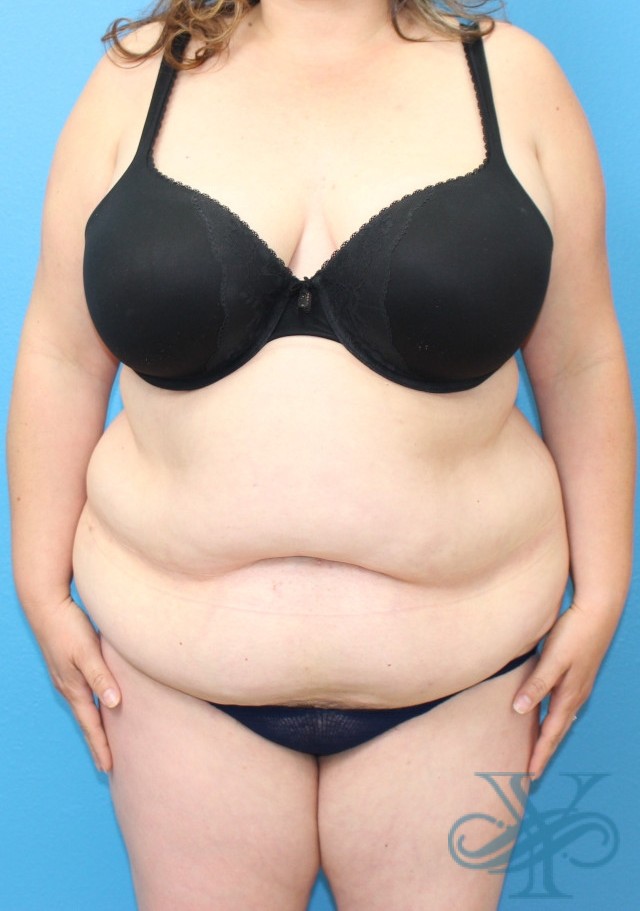 Before abdominoplasty Dr. Yegiyants, Santa Barbara, CA