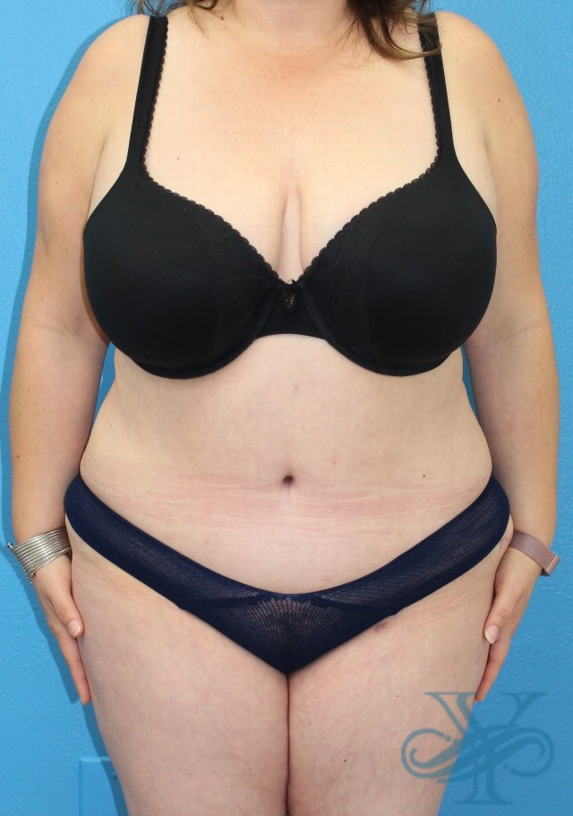 After abdominoplasty Dr. Yegiyants, Santa Barbara, CA