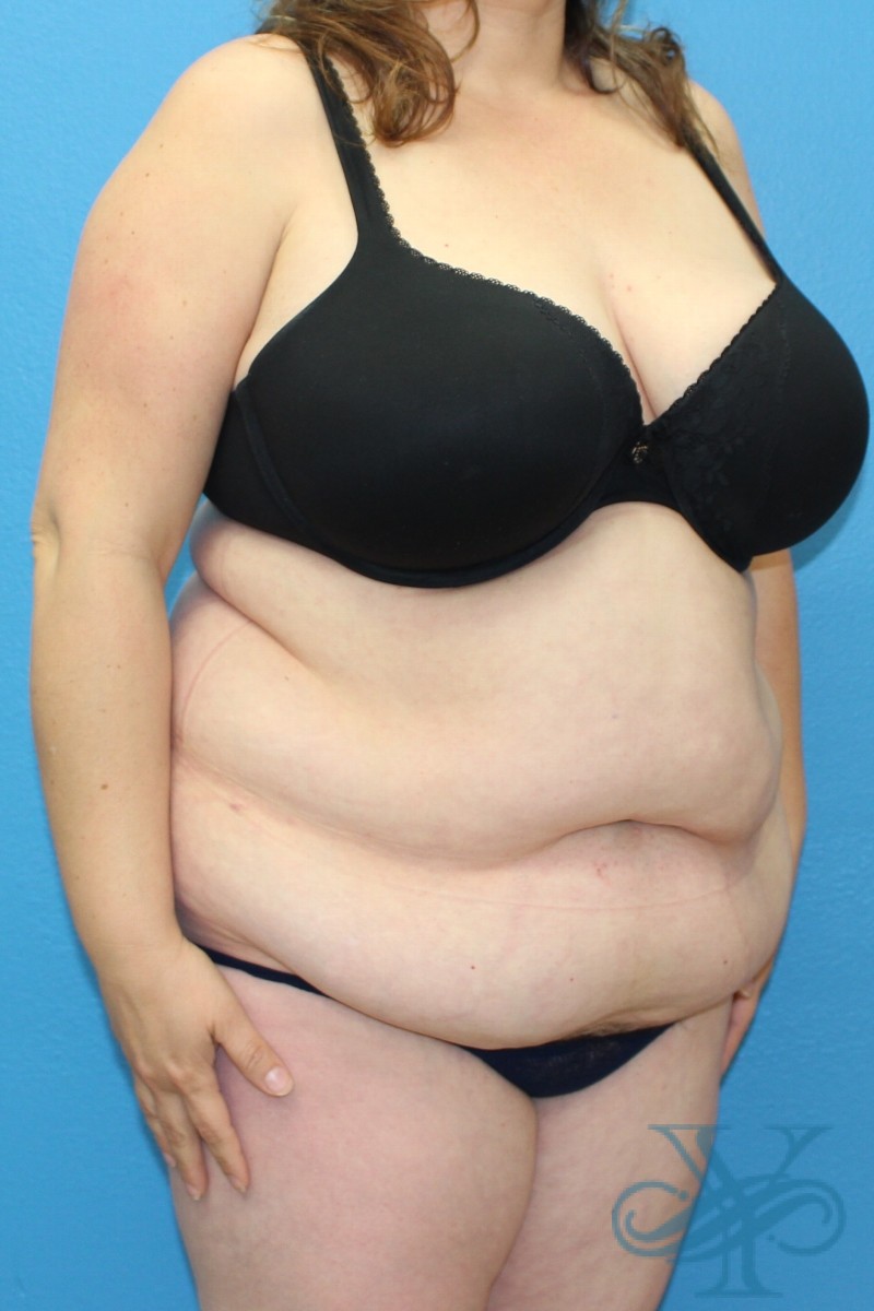 Before abdominoplasty Dr. Yegiyants, Santa Barbara, CA