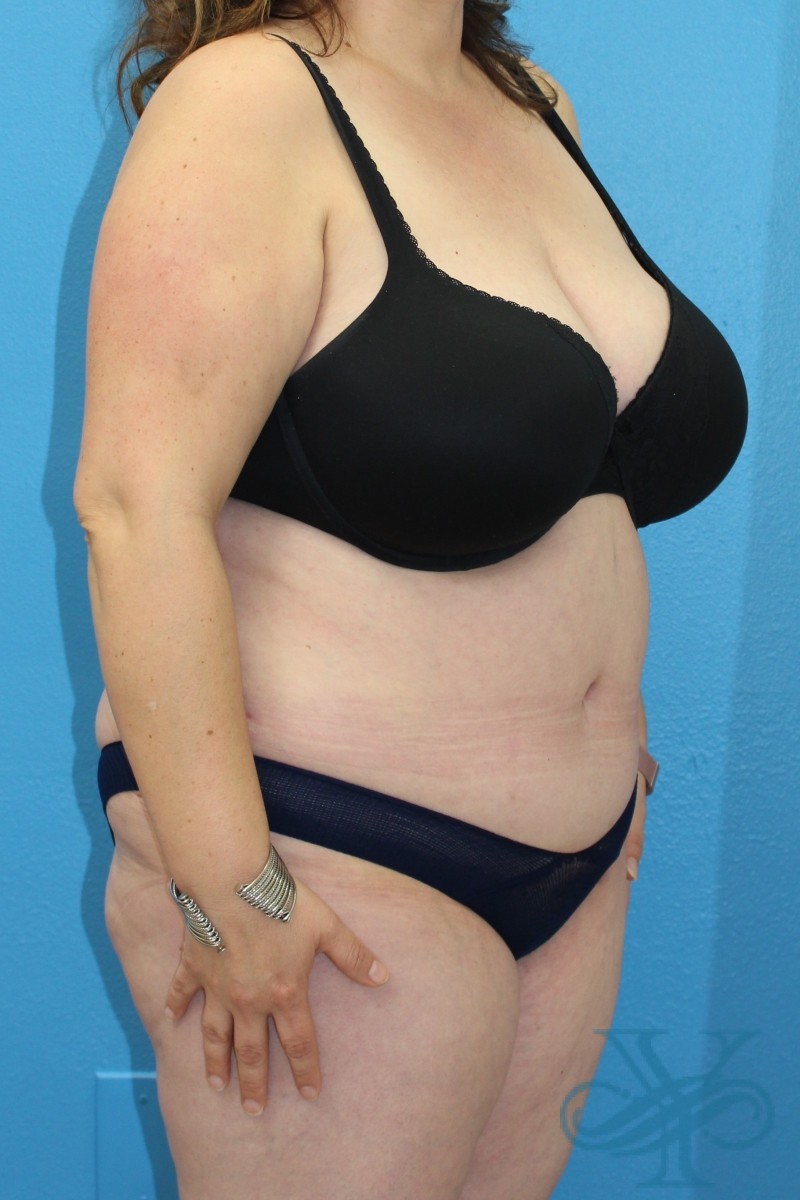 After abdominoplasty Dr. Yegiyants, Santa Barbara, CA