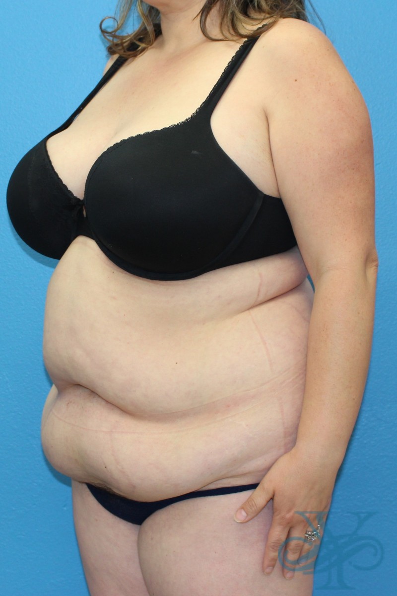 Before abdominoplasty Dr. Yegiyants, Santa Barbara, CA