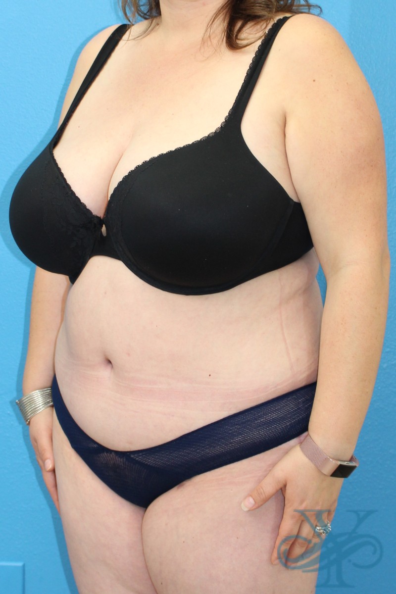 After abdominoplasty Dr. Yegiyants, Santa Barbara, CA