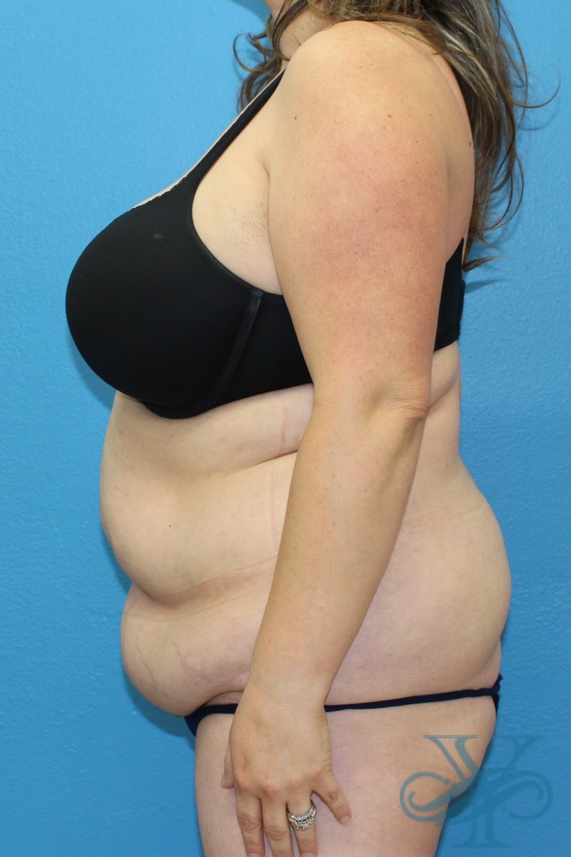 Before abdominoplasty Dr. Yegiyants, Santa Barbara, CA