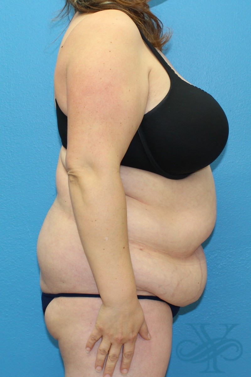 Before abdominoplasty Dr. Yegiyants, Santa Barbara, CA