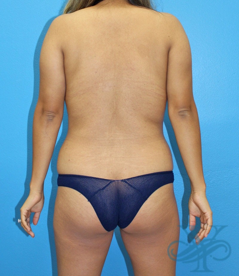 Before brazilian butt lift liposuction Dr. Yegiyants, Santa Barbara, CA