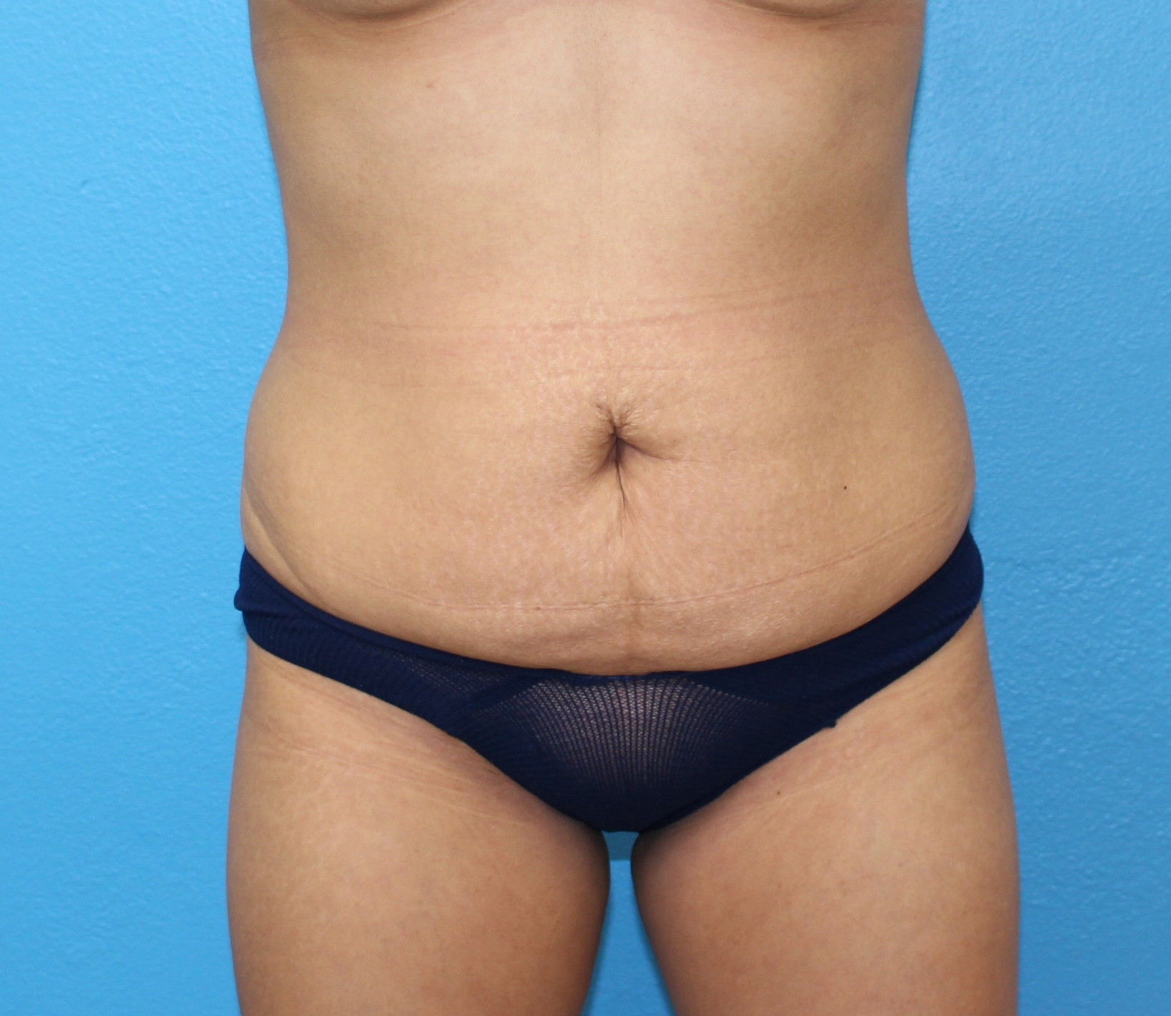 Before brazilian butt lift Dr. Yegiyants, Santa Barbara, CA