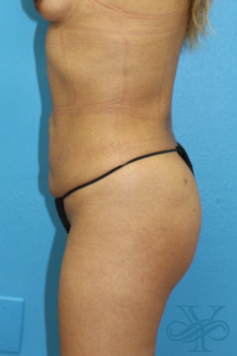 After brazilian butt lift Dr. Yegiyants, Santa Barbara, CA