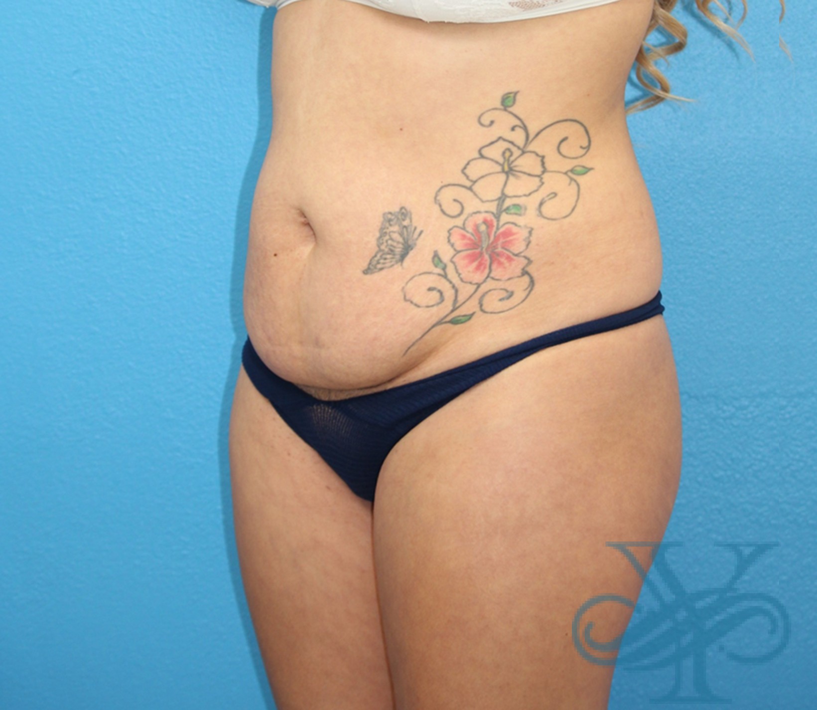 Before brazilian butt lift liposuction Dr. Yegiyants, Santa Barbara, CA