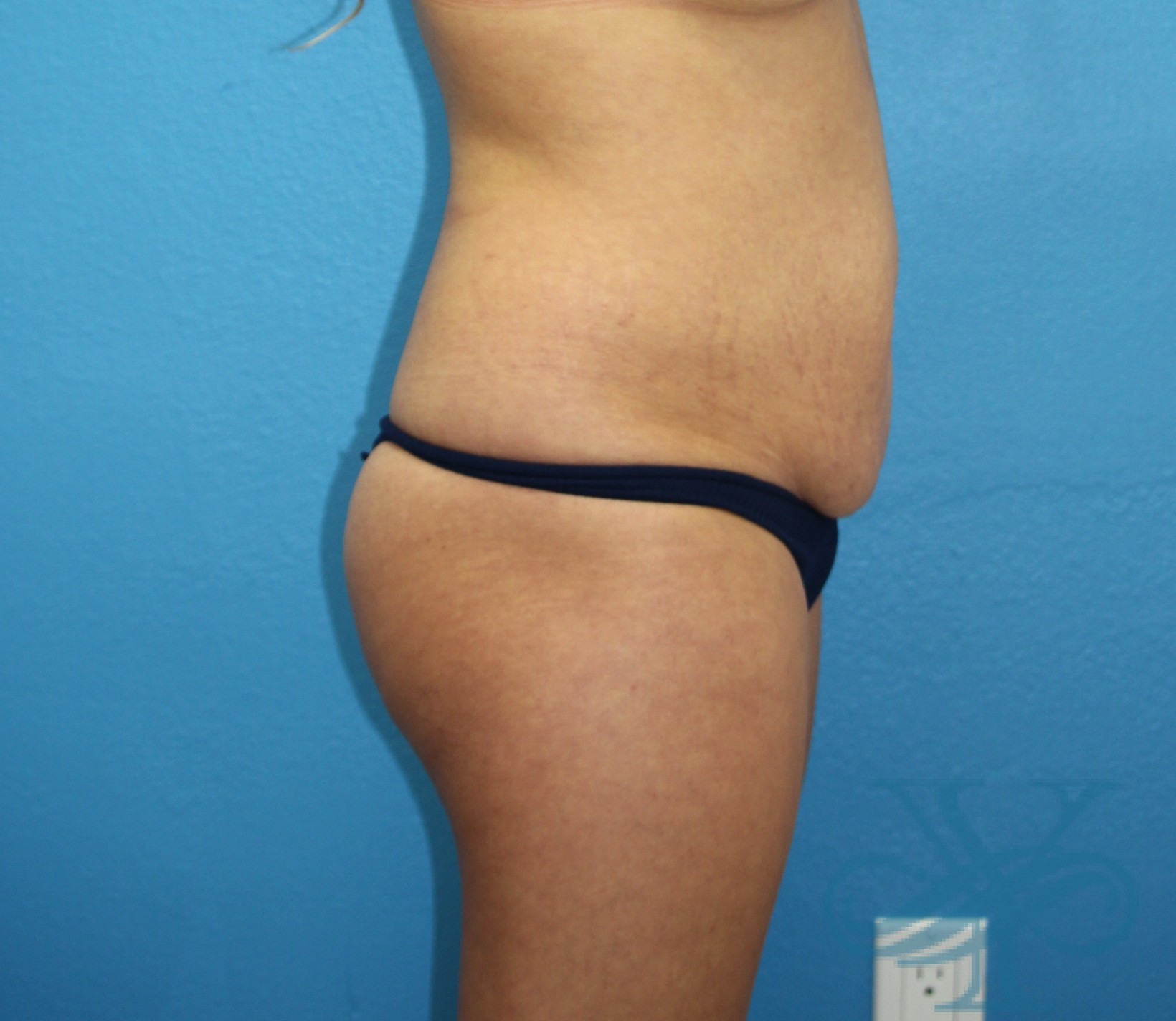 Before brazilian butt lift liposuction Dr. Yegiyants, Santa Barbara, CA