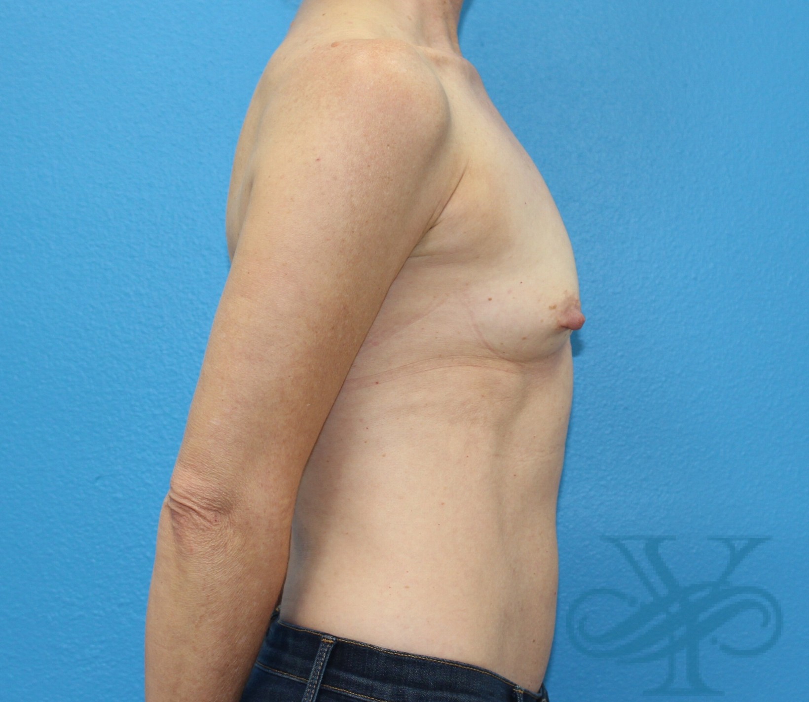 before breast augmentation right profile view