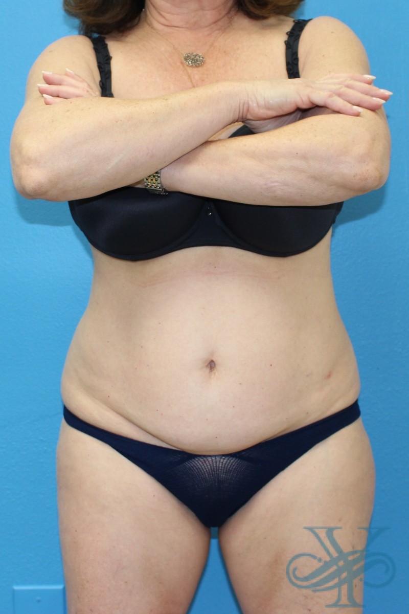 Before coolsculpting Dr. Yegiyants, Santa Barbara, CA