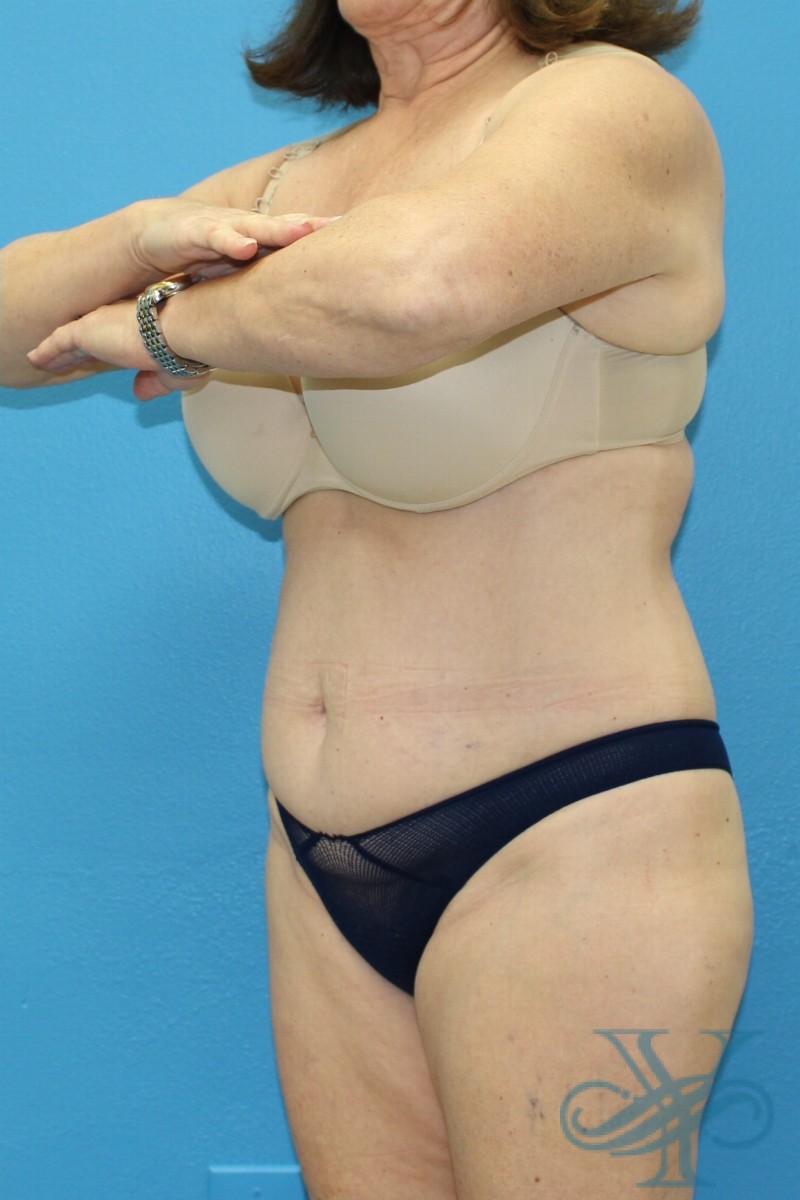After coolsculpting Dr. Yegiyants, Santa Barbara, CA