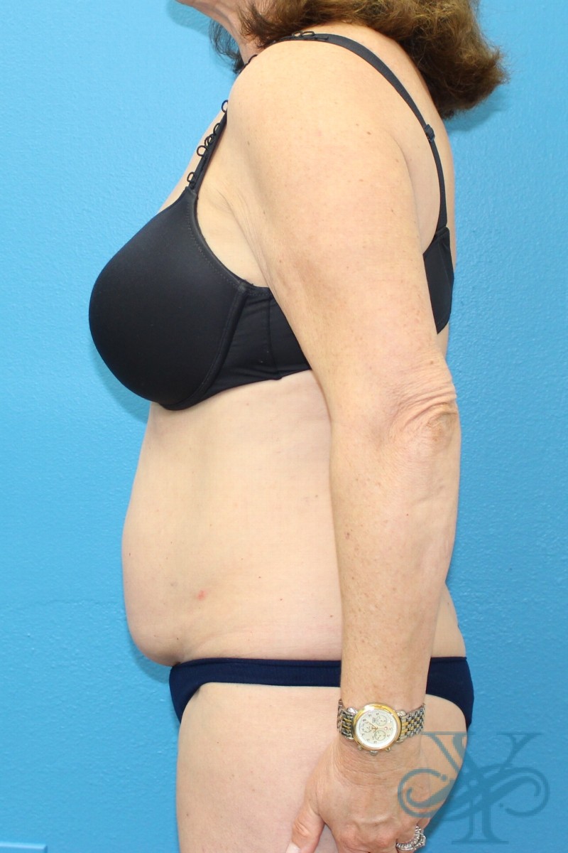 Before coolsculpting Dr. Yegiyants, Santa Barbara, CA