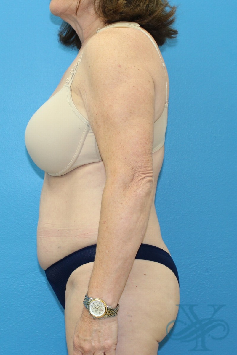 After coolsculpting Dr. Yegiyants, Santa Barbara, CA