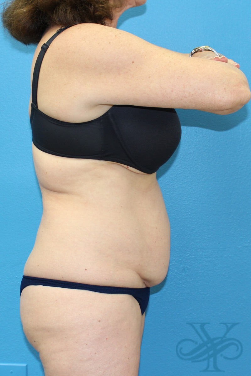 Before coolsculpting Dr. Yegiyants, Santa Barbara, CA