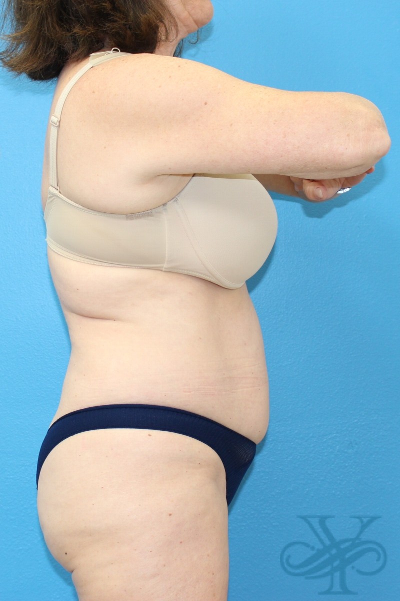 After coolsculpting Dr. Yegiyants, Santa Barbara, CA