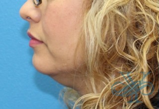 Before Kybella Dr. Yegiyants, Santa Barbara, CA