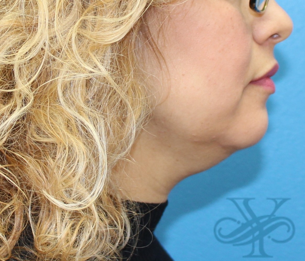 Before Kybella Dr. Yegiyants, Santa Barbara, CA