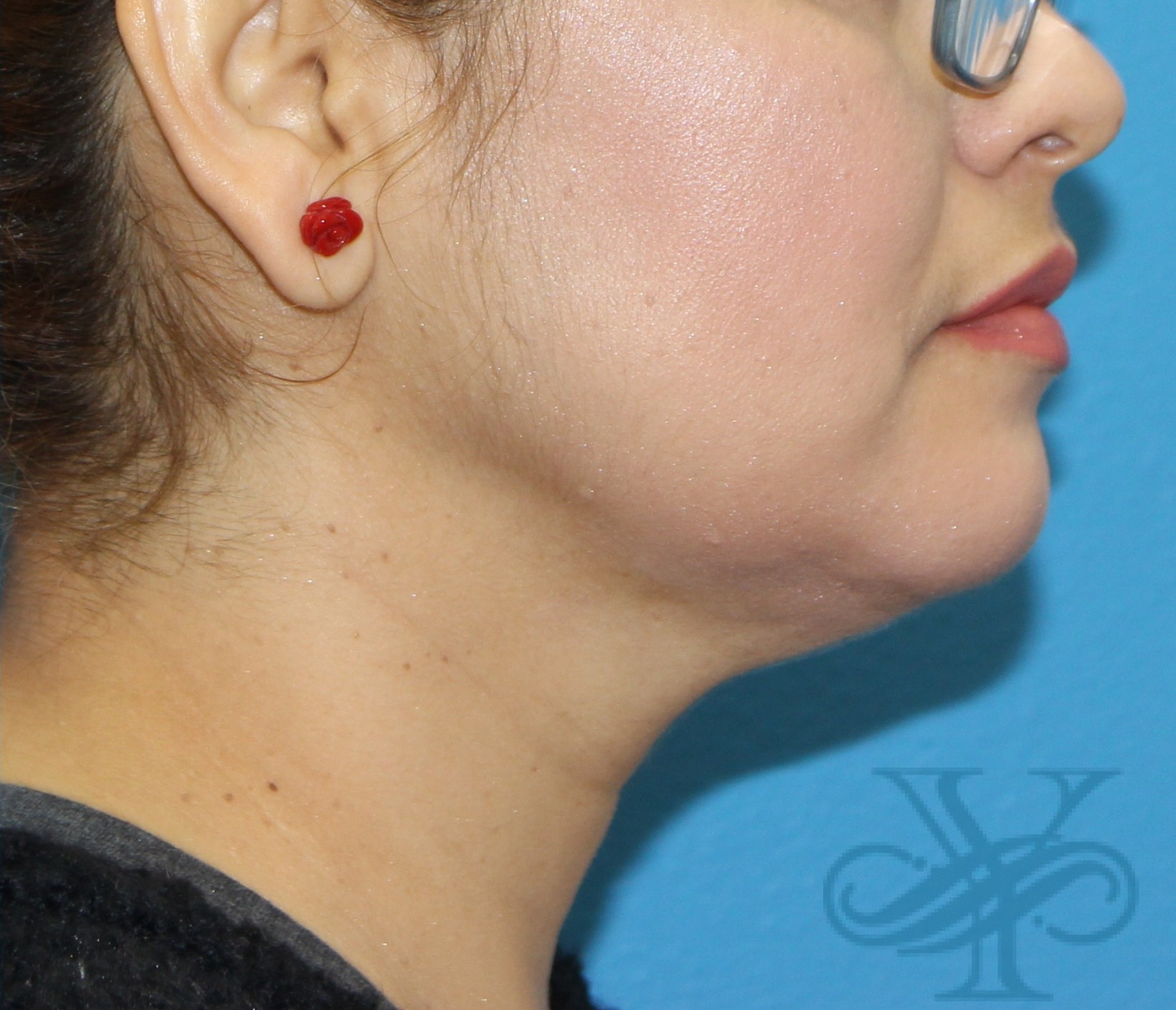 After Kybella Dr. Yegiyants, Santa Barbara, CA