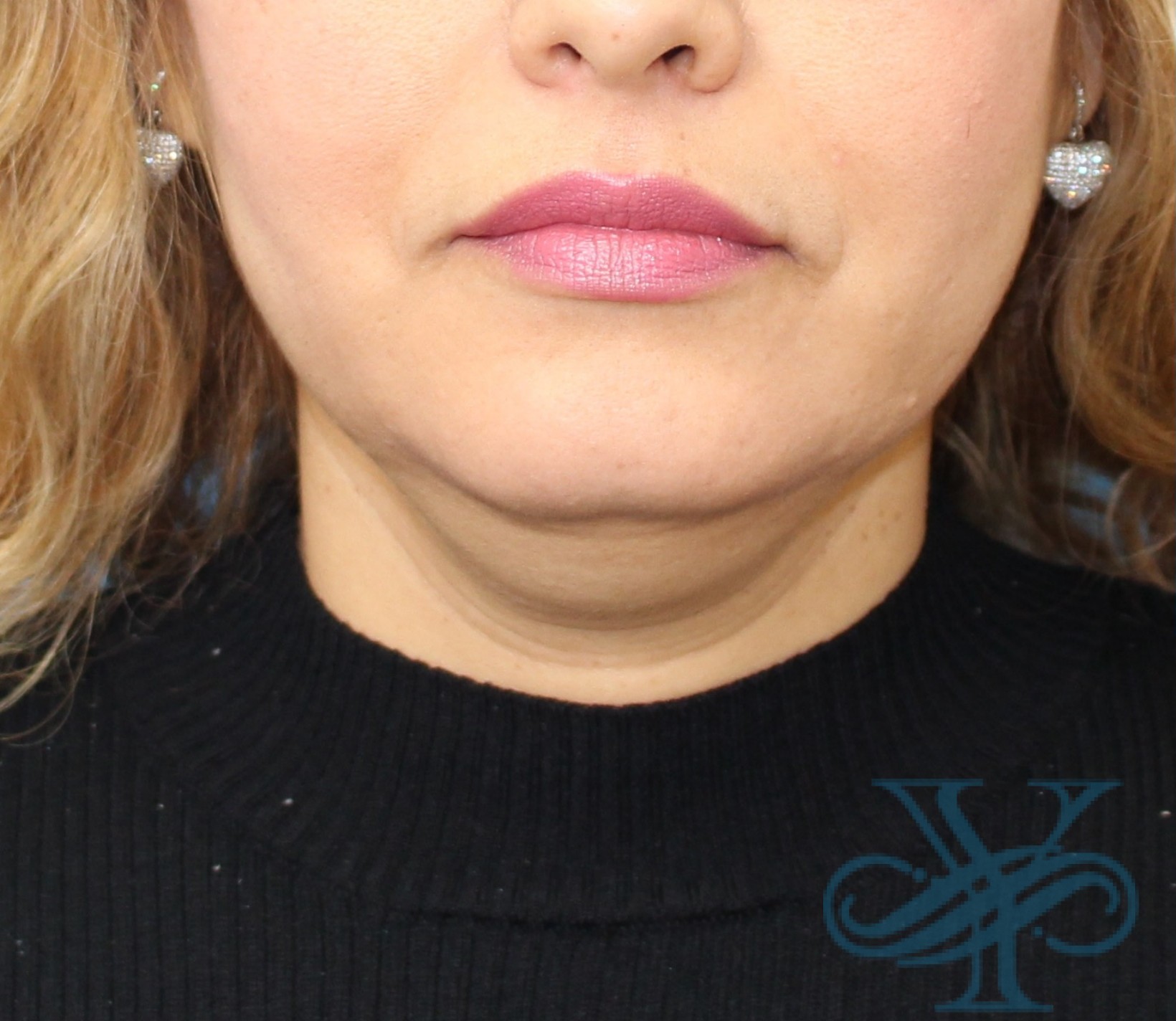 Before Kybella Dr. Yegiyants, Santa Barbara, CA