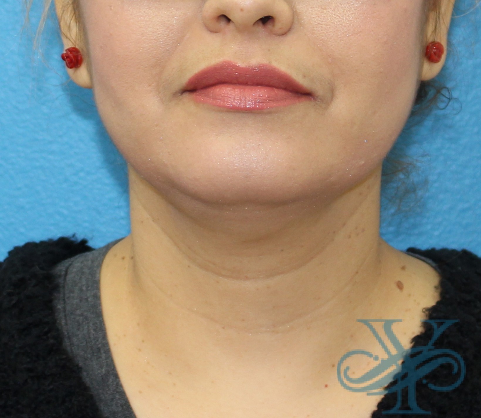 After Kybella Dr. Yegiyants, Santa Barbara, CA