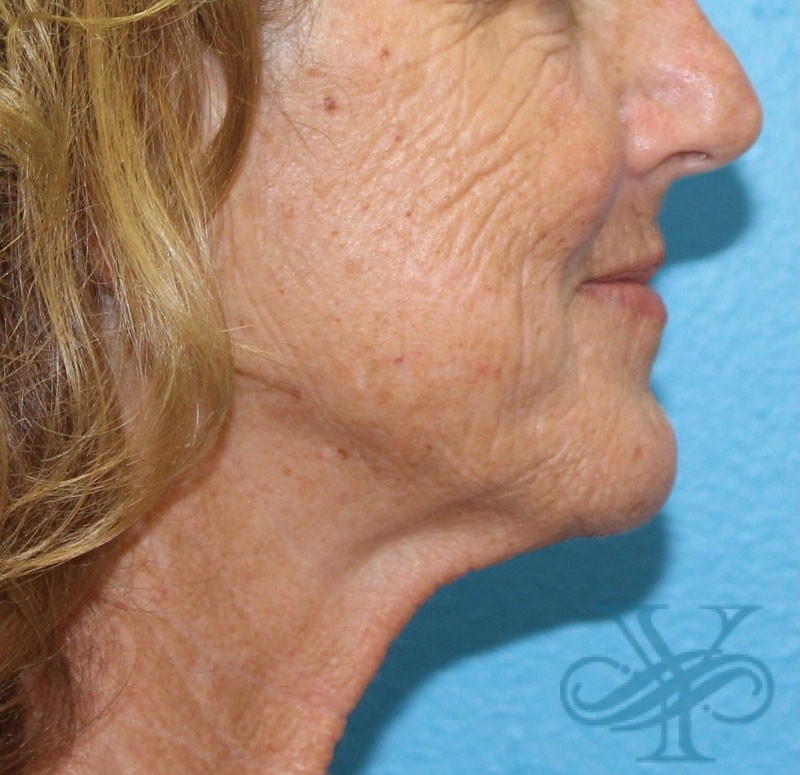 Before laser treatment Dr. Yegiyants, Santa Barbara, CA