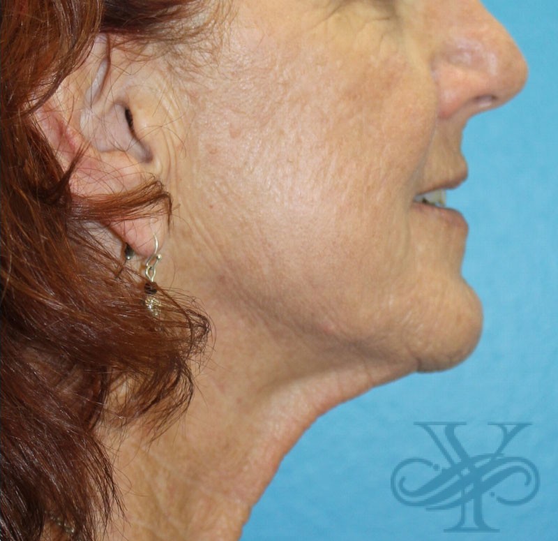 After laser treatment Dr. Yegiyants, Santa Barbara, CA
