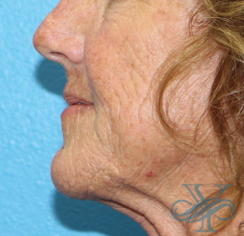 Before laser treatment Dr. Yegiyants, Santa Barbara, CA