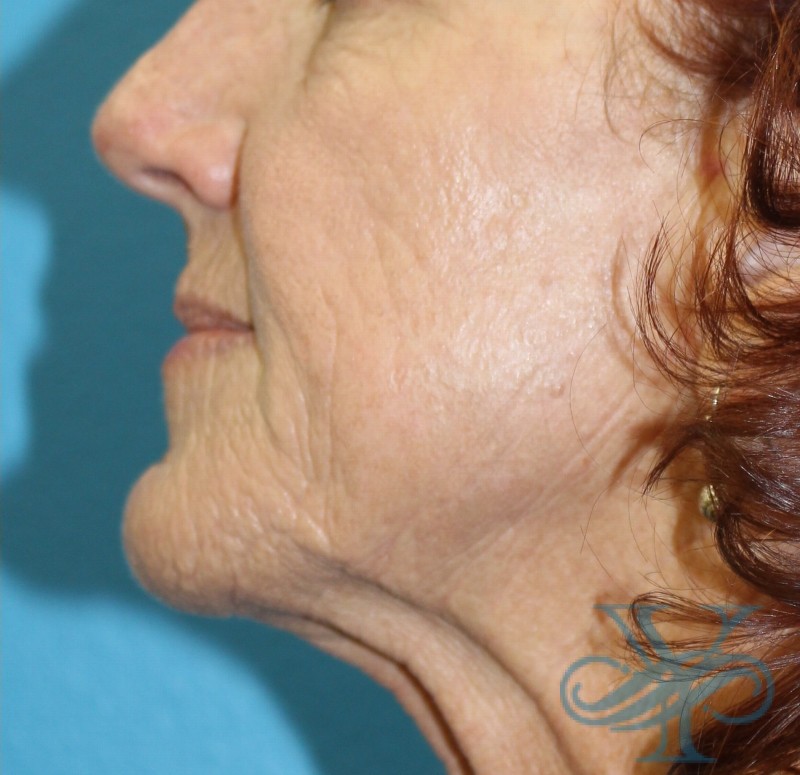 After laser treatment Dr. Yegiyants, Santa Barbara, CA