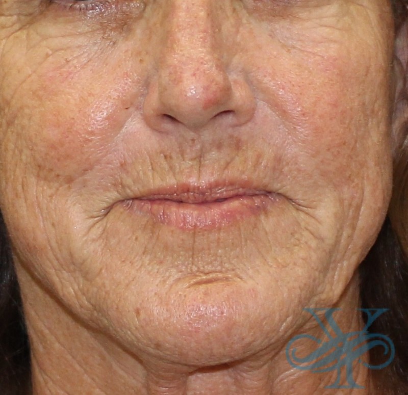 Before laser treatment Dr. Yegiyants, Santa Barbara, CA