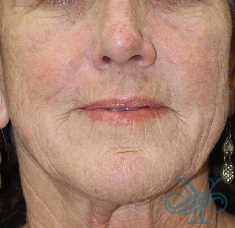After laser treatment Dr. Yegiyants, Santa Barbara, CA