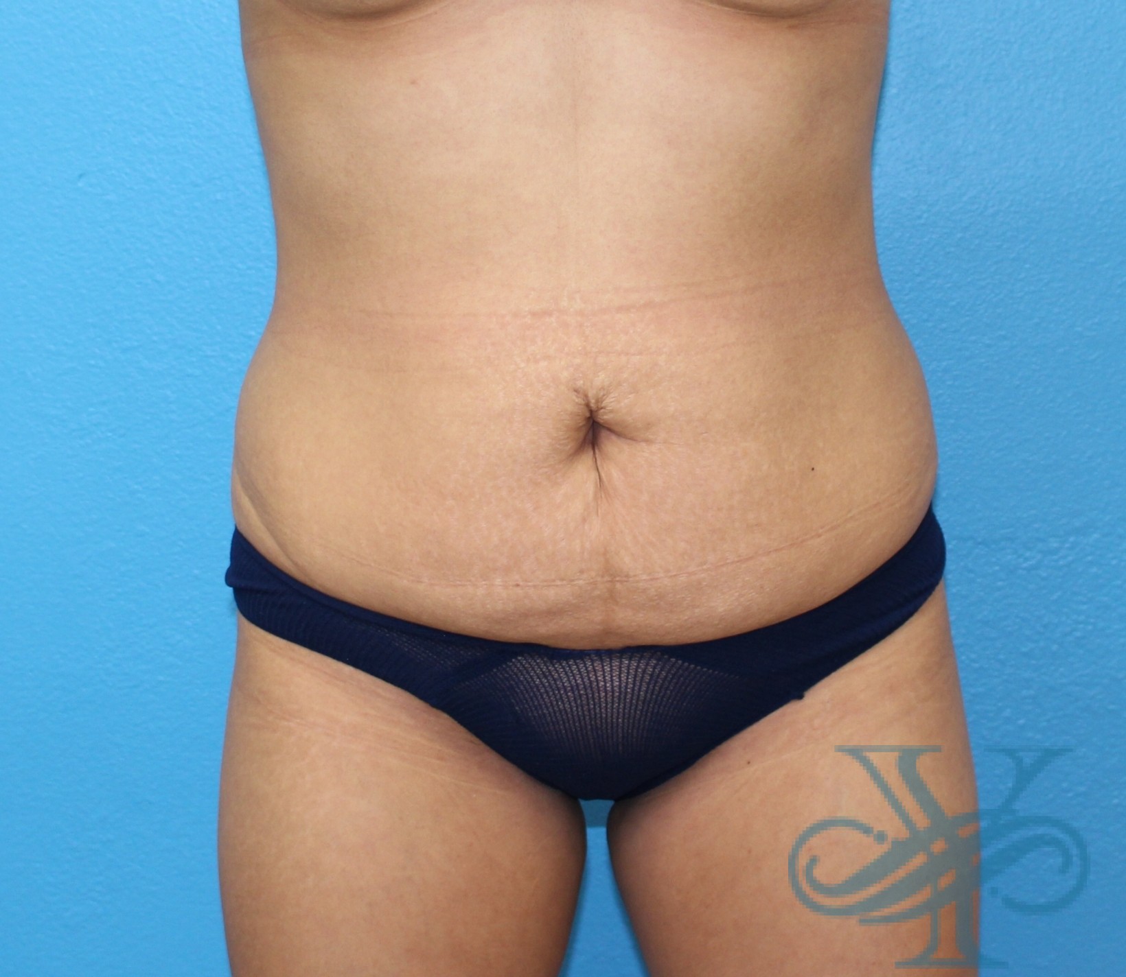 After liposuction Dr. Yegiyants, Santa Barbara, CA