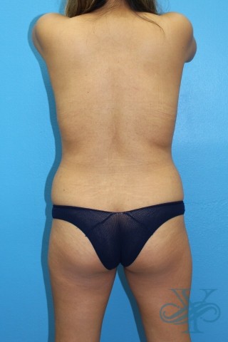 After liposuction Dr. Yegiyants, Santa Barbara, CA