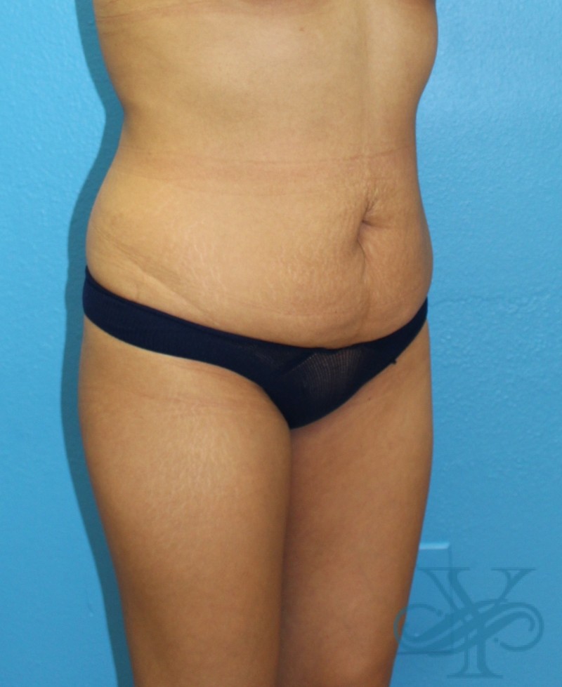 Before liposuction Dr. Yegiyants, Santa Barbara, CA