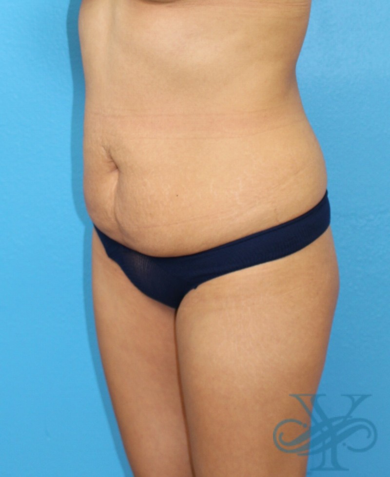 Before liposuction Dr. Yegiyants, Santa Barbara, CA