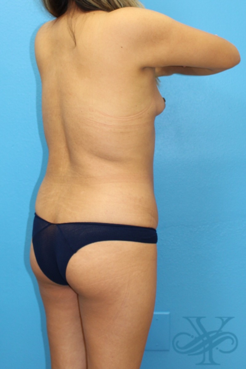 Before liposuction Dr. Yegiyants, Santa Barbara, CA