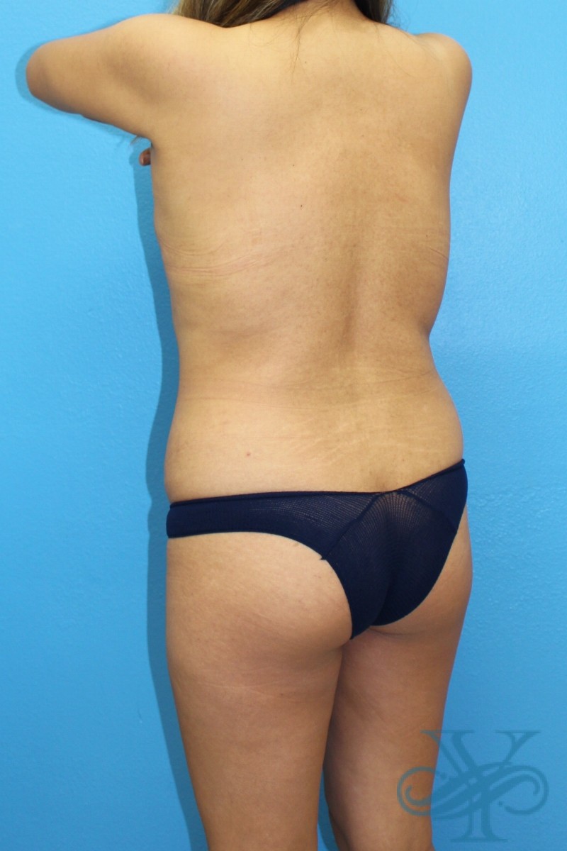 Before liposuction Dr. Yegiyants, Santa Barbara, CA